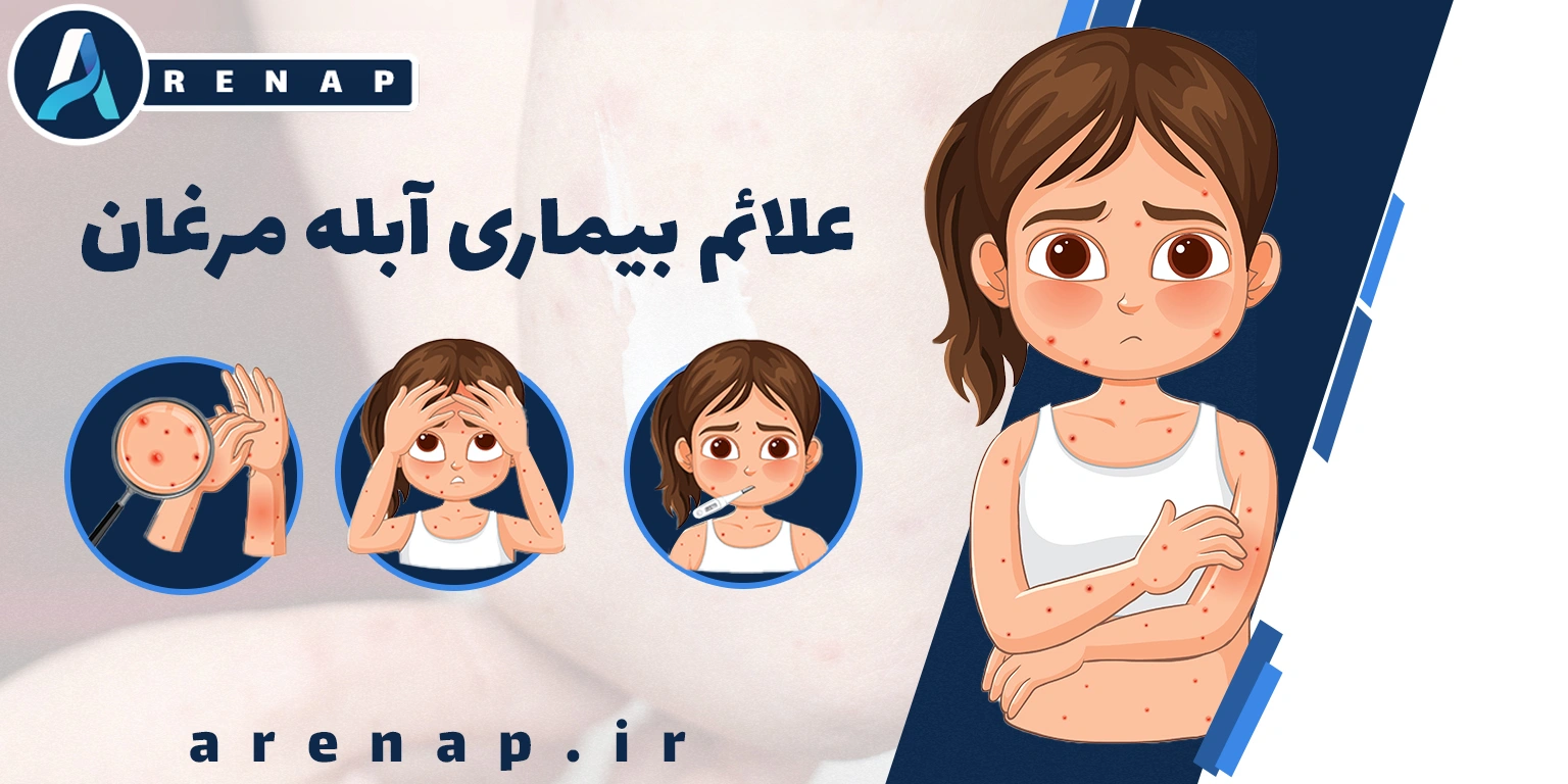 بیماری آبله مرغان در کودکان و بزرگسالان، خارش پوست و اهمیت درمان سریع