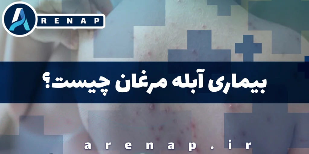 آبله مرغان چیست و چگونه درمان می‌شود؟ بررسی کامل در کودکان و بزرگسالان