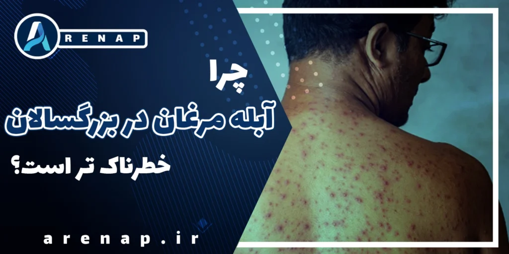 آبله مرغان چیست و چرا در بزرگسالان شدیدتر است؛ نمایی از بثورات پوستی
