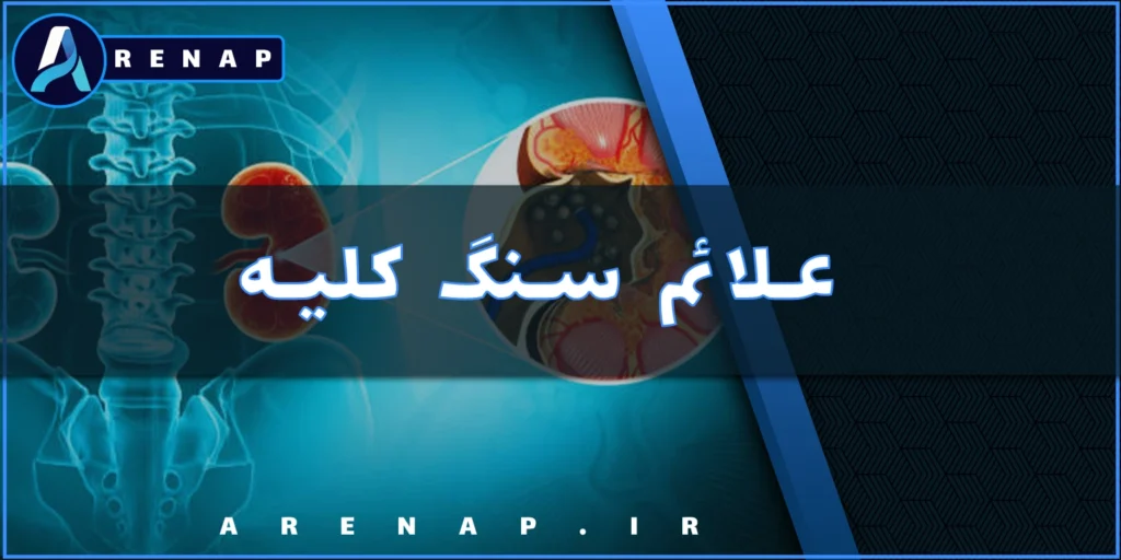 علائم رایج سنگ کلیه شامل درد پهلو و تغییر رنگ ادرار
