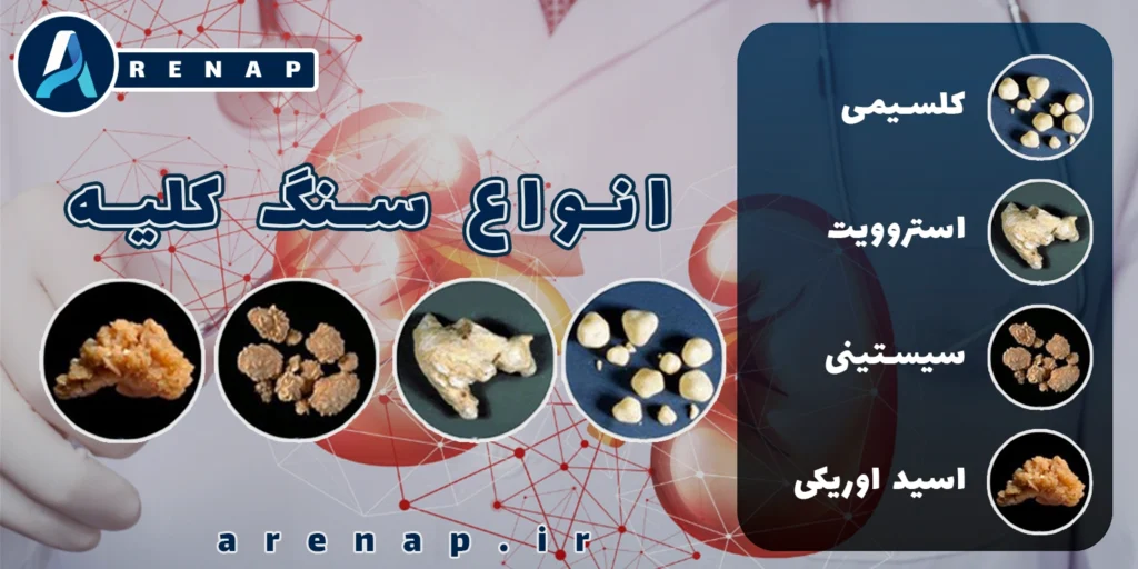 انواع سنگ کلیه بر اساس ترکیب شیمیایی و اندازه
