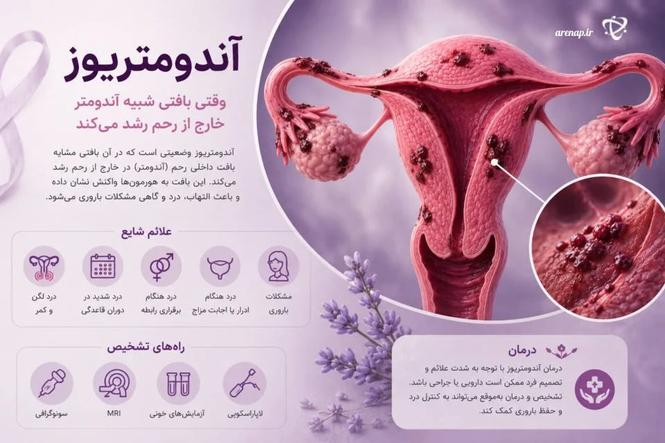 آندومتریوز از بیماری‌های مزمن زنان