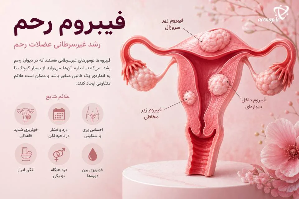 فیبروم رحم از بیماری‌های خوش‌خیم زنان