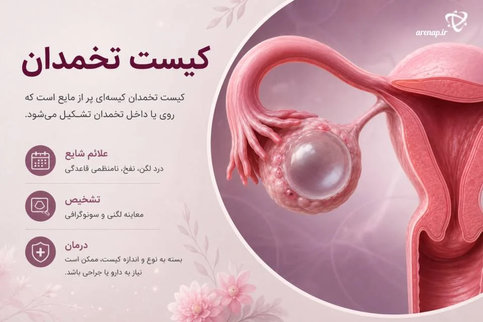 کیست تخمدان از اختلالات شایع بیماری زنان