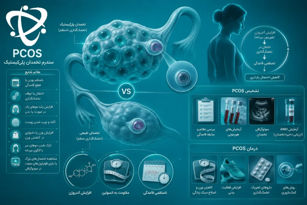 تصویر پزشکی سندرم تخمدان پلی‌کیستیک (PCOS) یکی از شایع‌ترین علت‌های ناباروری در زنان.
