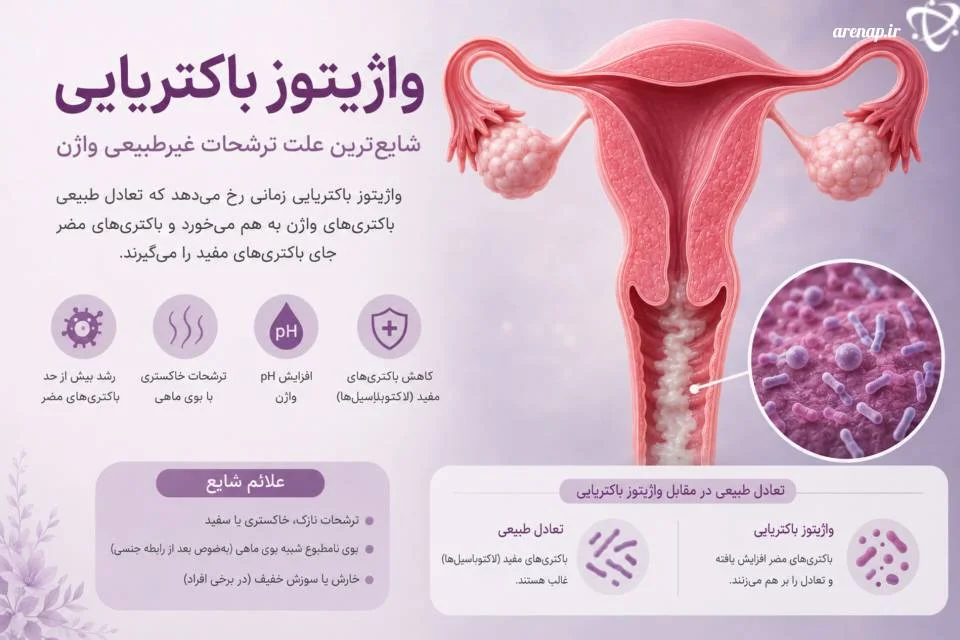 واژینوز باکتریایی از بیماری‌های شایع زنان