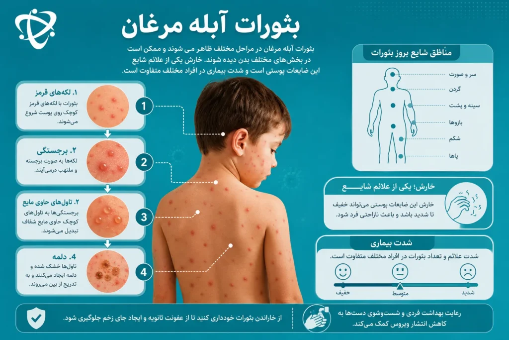 مراحل ایجاد بثورات آبله مرغان از لکه‌های قرمز تا تاول و دلمه پوستی