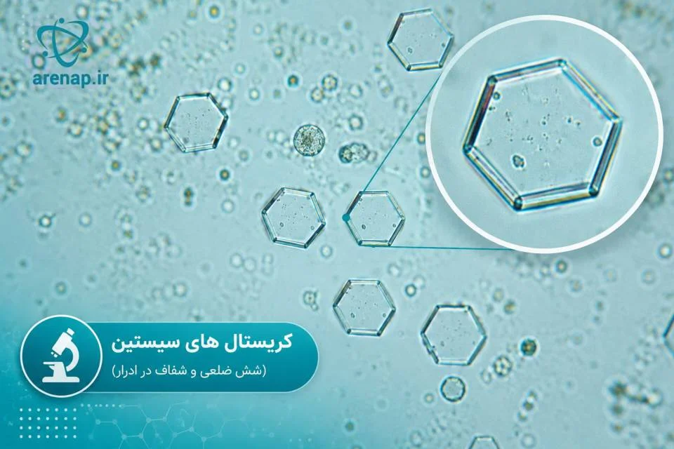نمای میکروسکوپی کریستال‌های شش‌ضلعی سیستین در ادرار -ارناپ