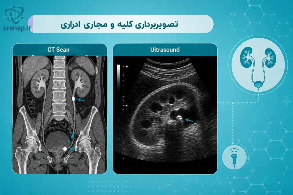 نمای سی‌تی‌اسکن یا سونوگرافی کلیه و حالب -ارناپ