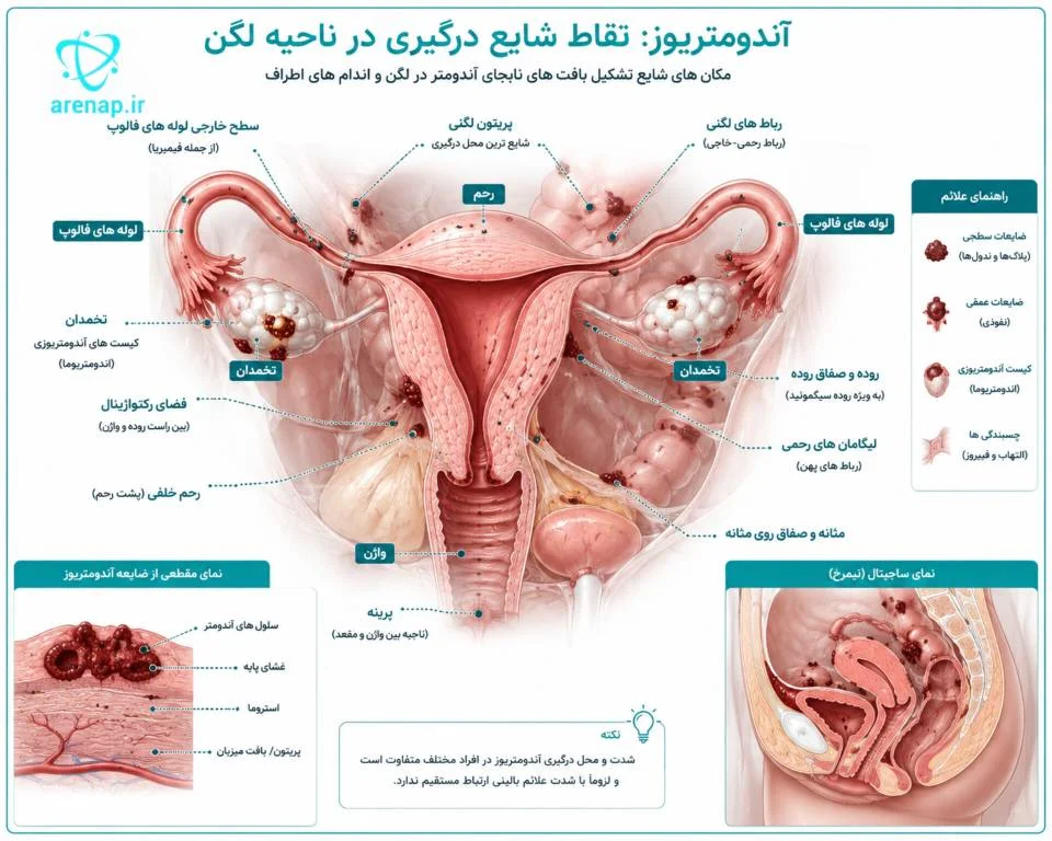 محل‌های شایع درگیری بیماری اندومتریوز در لگن و اندام‌های اطراف -ارناپ