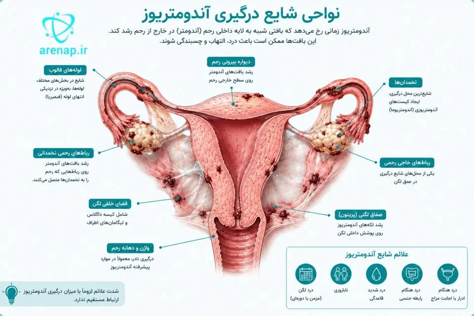 شماتیک رحم و محل‌های شایع اندومتریوز در تخمدان‌ها و لوله‌های فالوپ-ارناپ