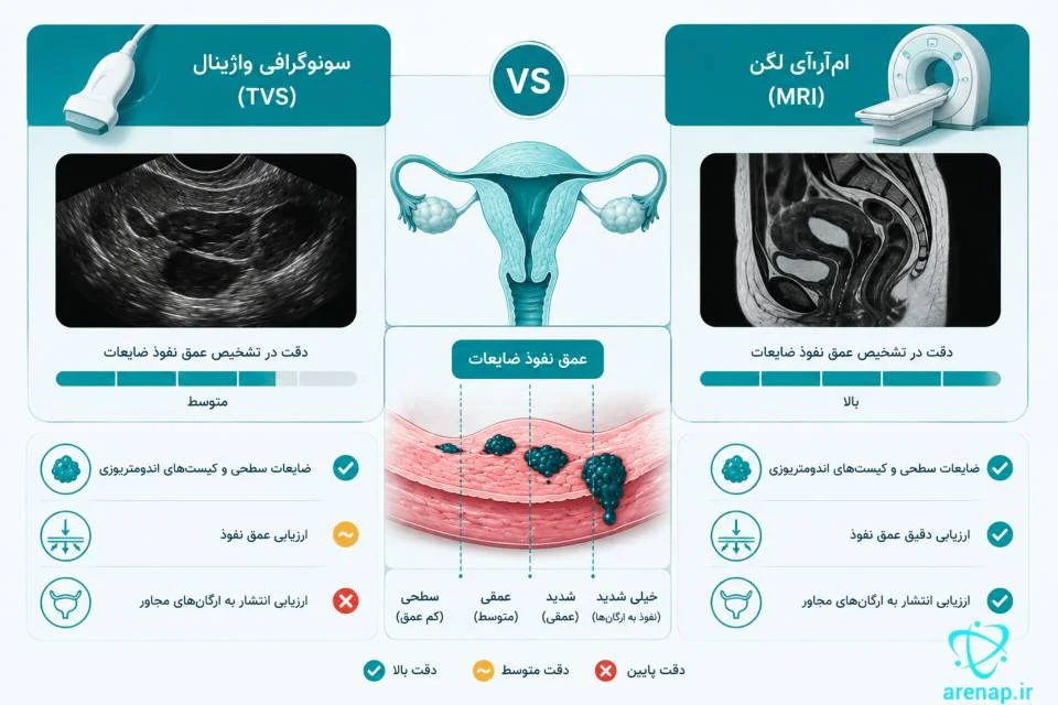 مقایسه سونوگرافی واژینال و MRI برای تشخیص ضایعات اندومتریوز-ارناپ