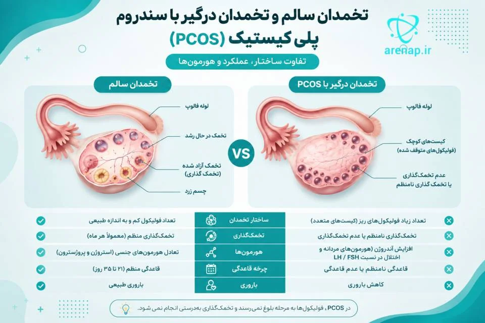 مقایسه تصویری تخمدان سالم با تخمدان مبتلا به سندروم تخمدان پلی‌کیستیک-ارناپ