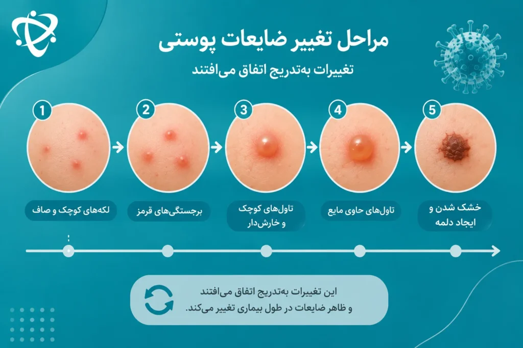 مراحل ضایعات پوستی آبله مرغان از لکه‌های قرمز و برجستگی تا تاول و دلمه