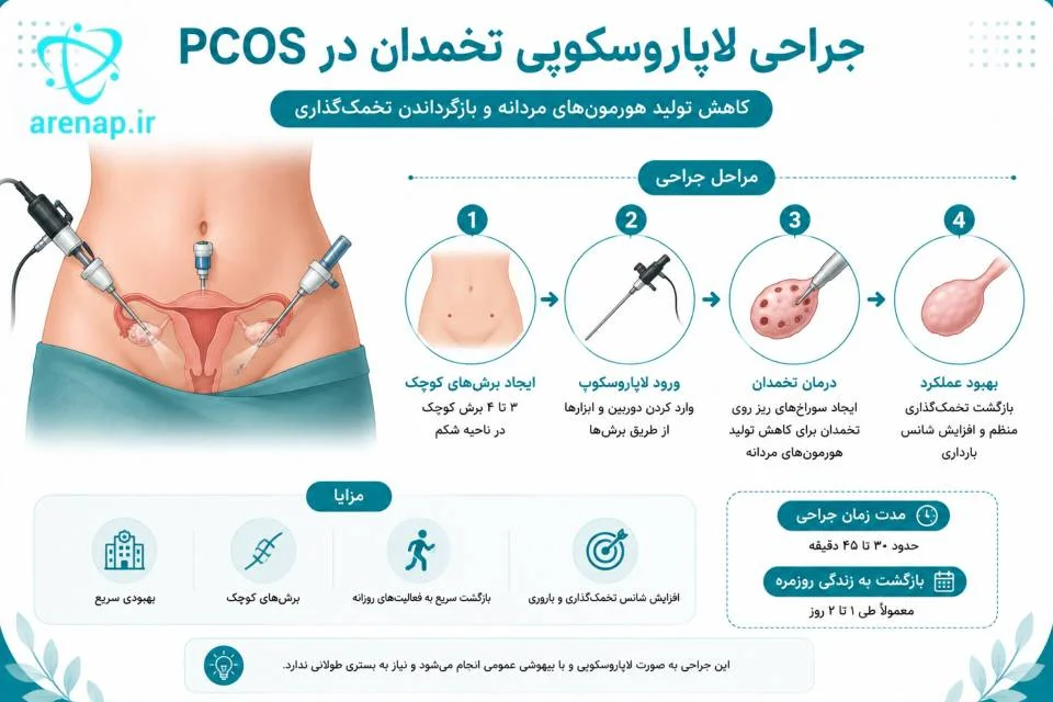 اینفوگرافیک ساده از فرایند جراحی لاپاروسکوپی تخمدان در سندروم تخمدان پلی‌کیستیک-ارناپ
