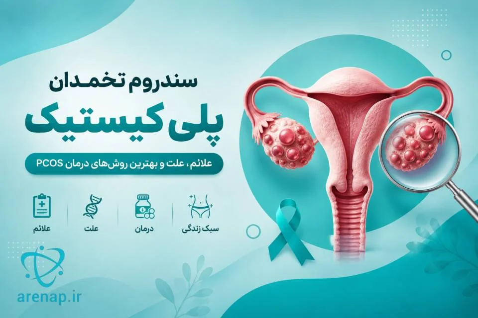 سندروم تخمدان پلی کیستیک