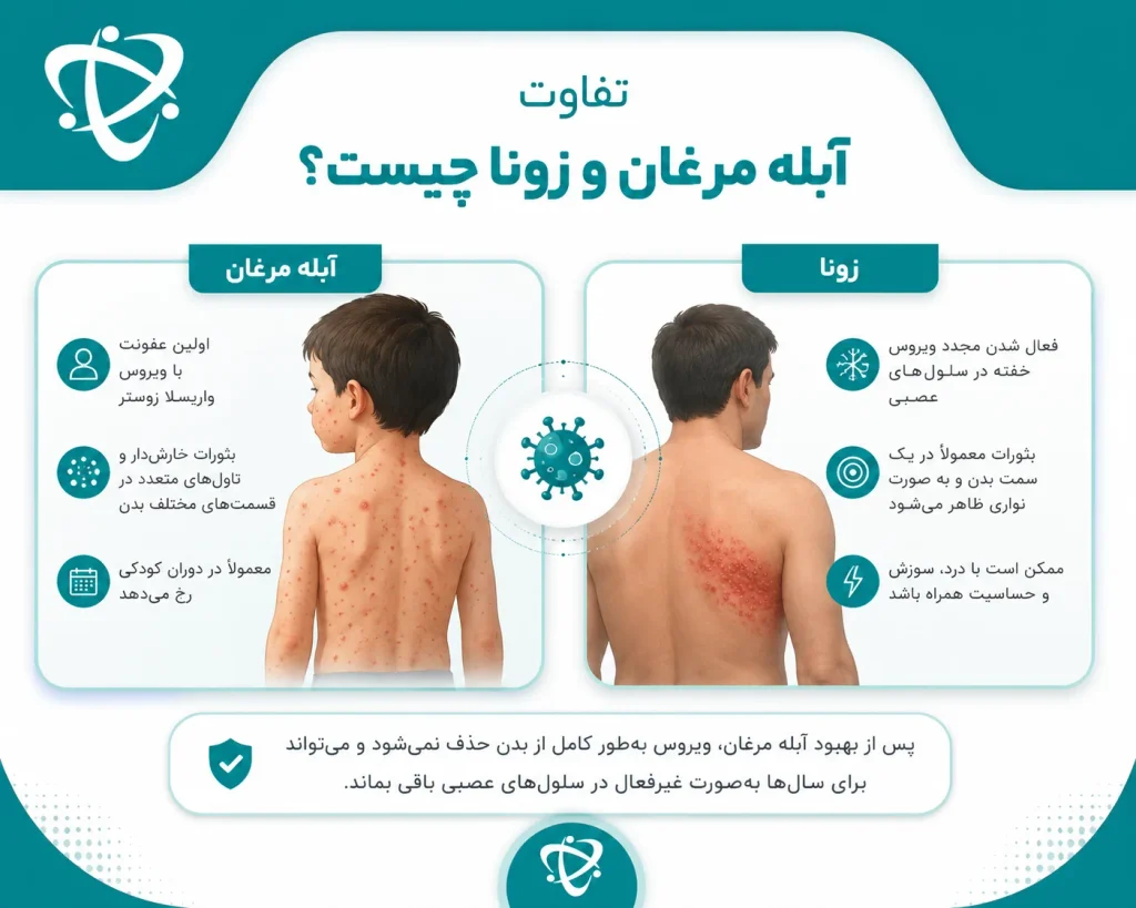 آبله مرغان و زونا؛ تفاوت دو بیماری ناشی از ویروس واریسلا زوستر