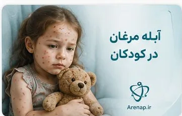 آبله مرغان در کودکان-ارناپ