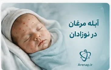 آبله مرغان در نوزادان-ارناپ