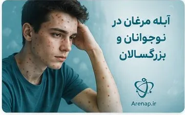 آبله مرغان در نوجوانان و بزرگسالان-ارناپ