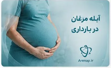 آبله مرغان در بارداری-ارناپ