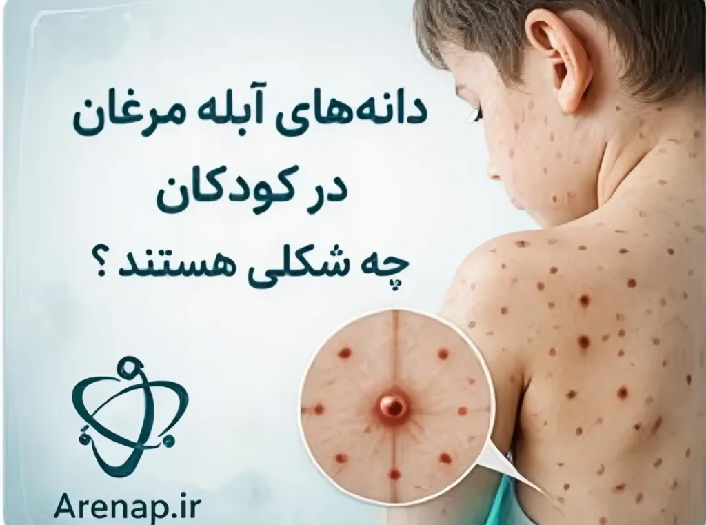 دانه‌های آبله مرغان چه شکلی هستند- ارناپ