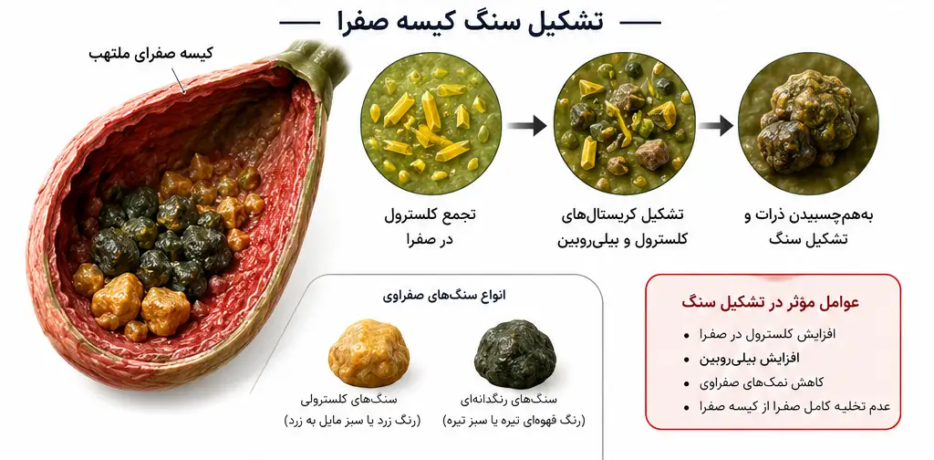 تشکیل سنگ کیسه صفرا و تجمع کریستالهای کلسترول و بیلیروبین در کیسه صفرا، همراه با نمایش انواع سنگ صفرا و عوامل مؤثر بر تشکیل آن