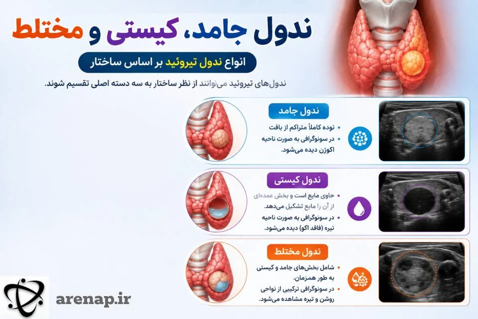 انواع ندول تیروئید؛ جامد، کیستی و مختلط_آرناپ
