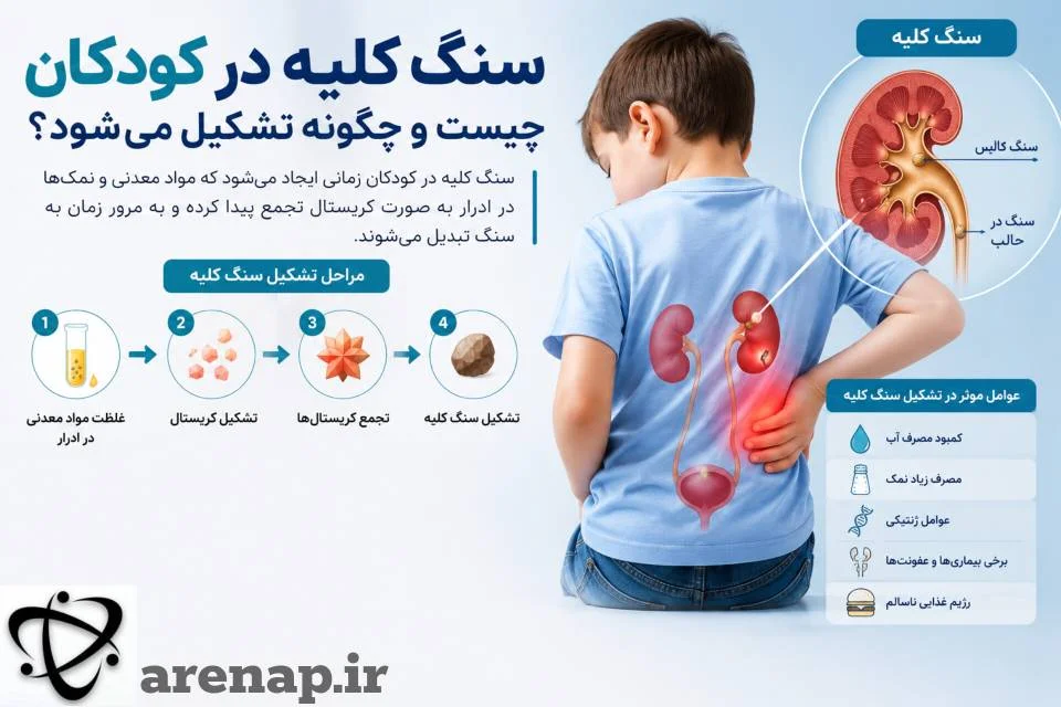 سنگ کلیه در کودکان؛ علل و تشکیل سنگ_آرناپ