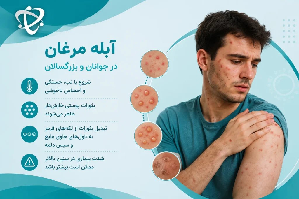 آبله مرغان در جوانان و بزرگسالان؛ تب، بثورات خارش‌دار و تبدیل لکه‌ها به تاول و دلمه