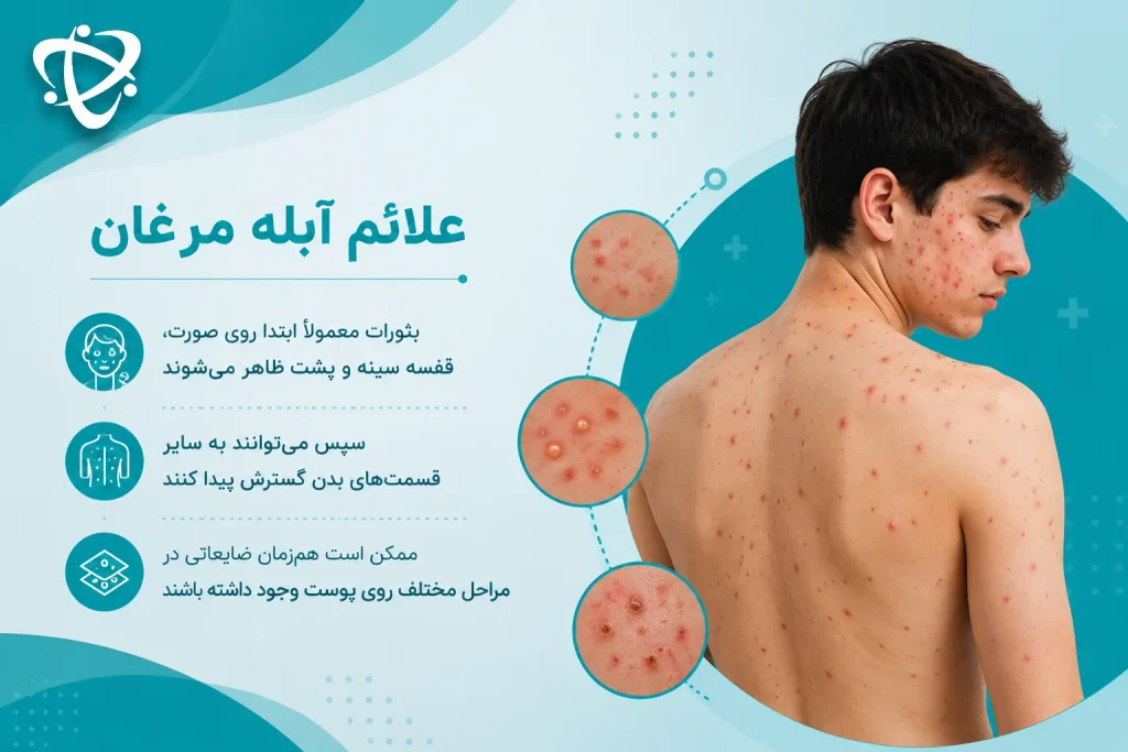 شروع آبله مرغان در بزرگسالان؛ علائم اولیه و روند ایجاد بثورات پوستی خارش‌دار
