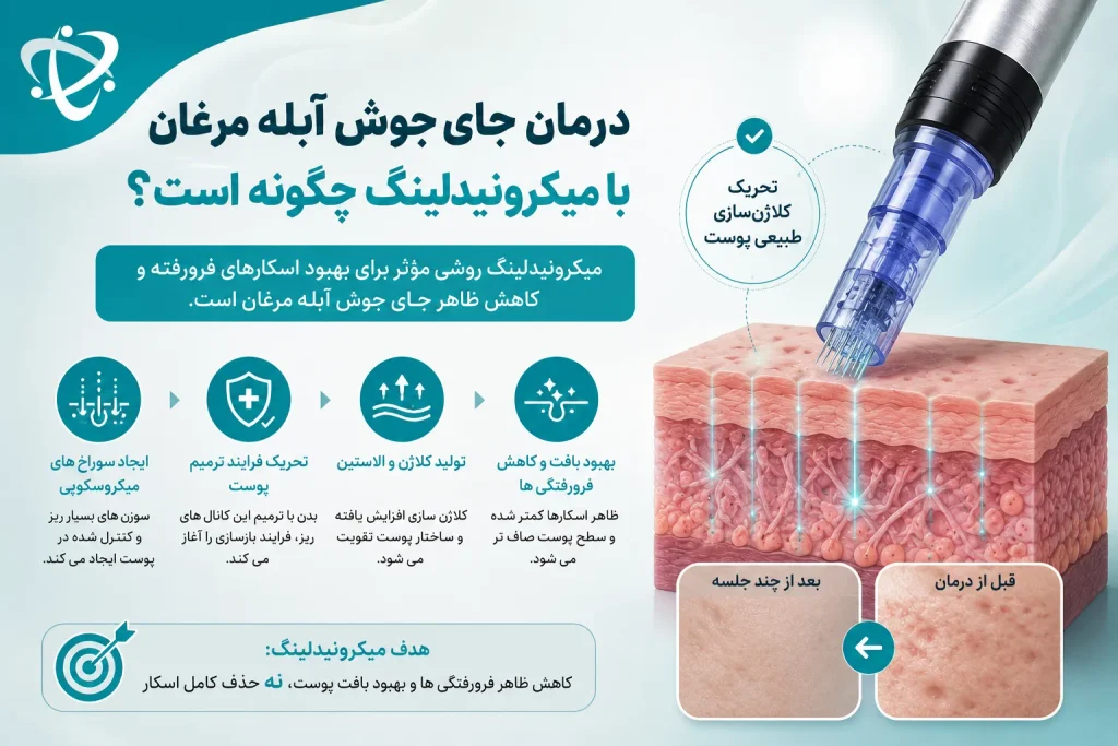 میکرونیدلینگ برای از بین بردن گودی جای آبله مرغان؛ تحریک کلاژن‌سازی