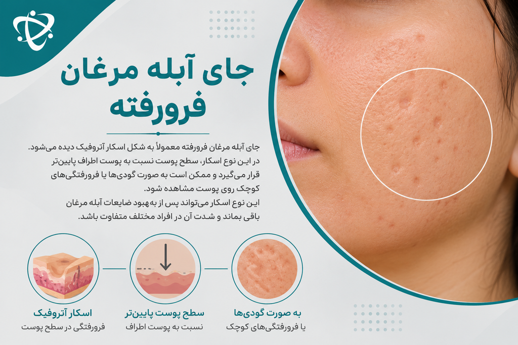 از بین بردن گودی جای آبله مرغان فرورفته؛ بهبود اسکار آتروفیک