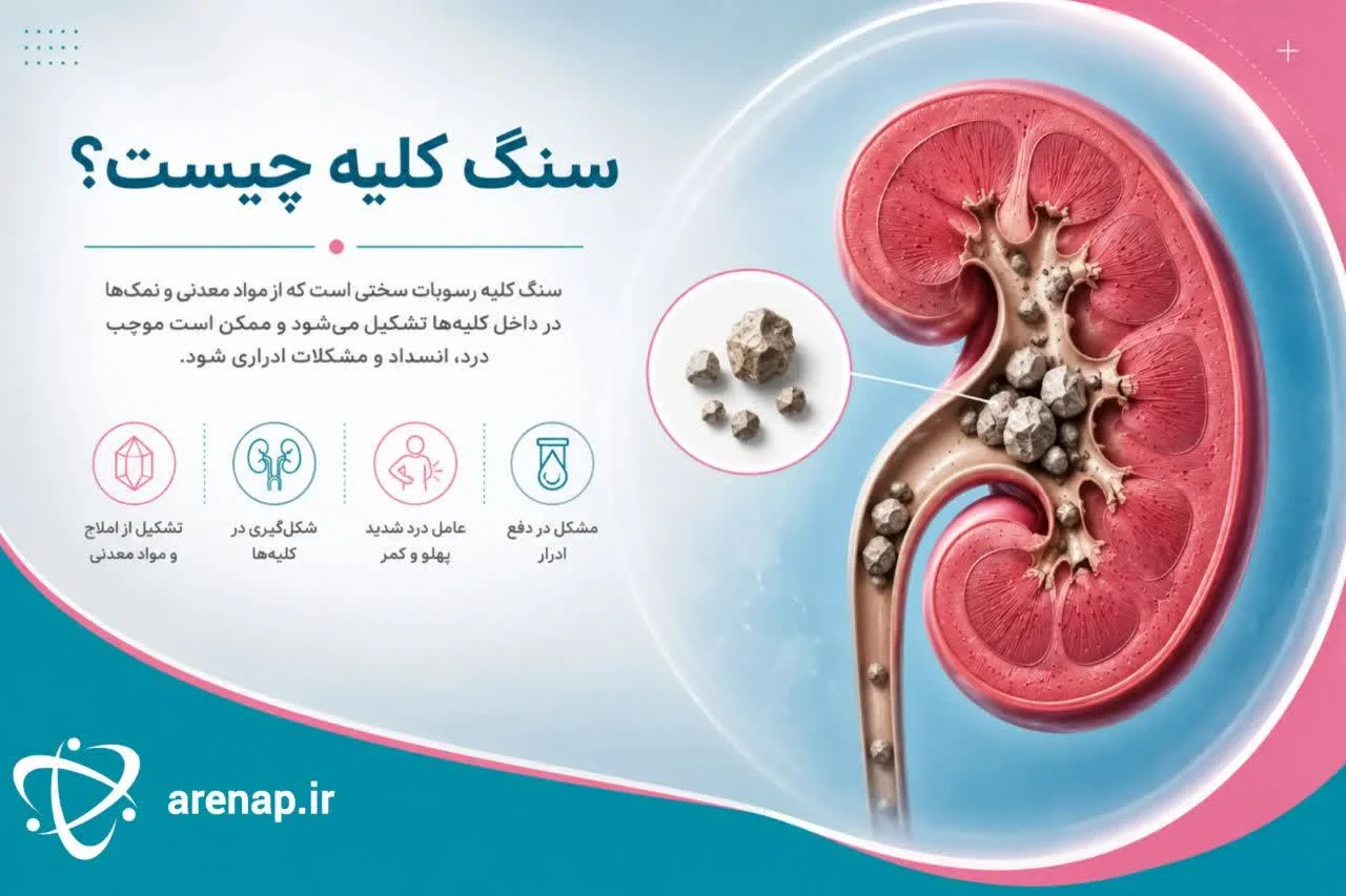 سنگ کلیه چیست؟ -ارناپ
