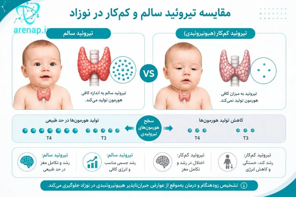 اینفوگرافیک مقایسه تیروئید سالم و کم‌کار در نوزاد و کاهش تولید هورمون‌های تیروئیدی -ارناپ