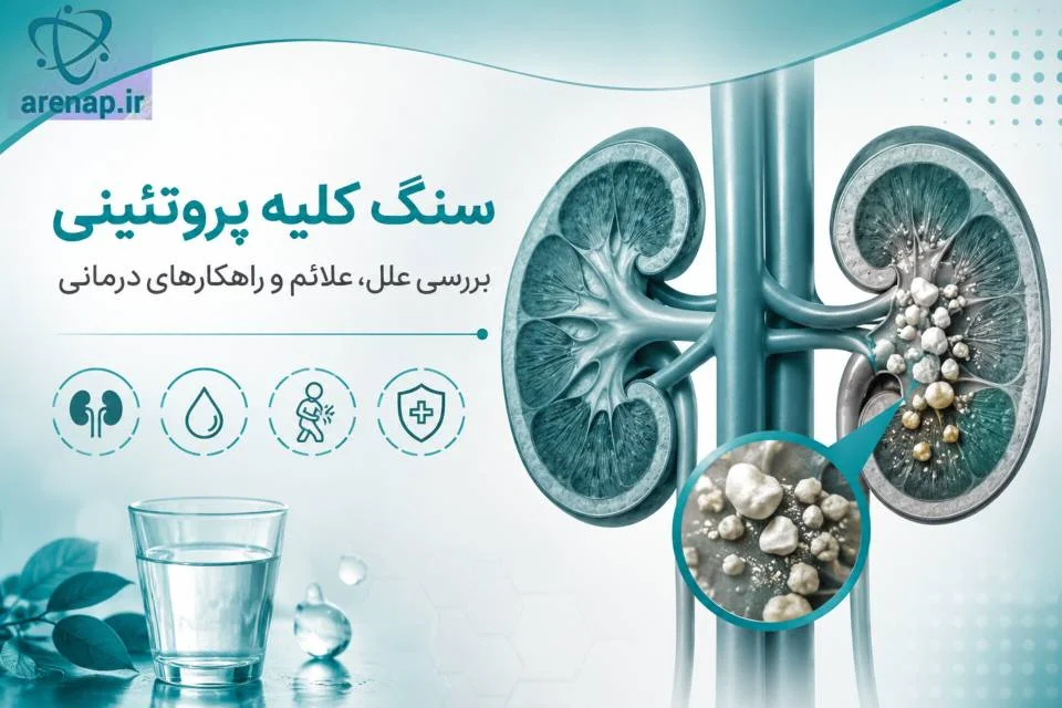 سنگ کلیه پروتئینی - آرناپ