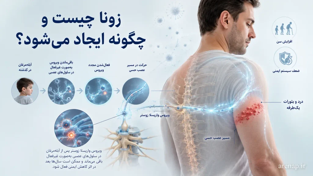 تصویر پزشکی از فعالشدن مجدد ویروس واریسلا زوستر و ایجاد زونا؛ مرتبط با درمان بیماری زونا
