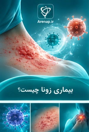بیماری زونا چیست-ارناپ