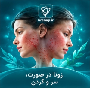 زونا در صورت، سر و گردن-ارناپ