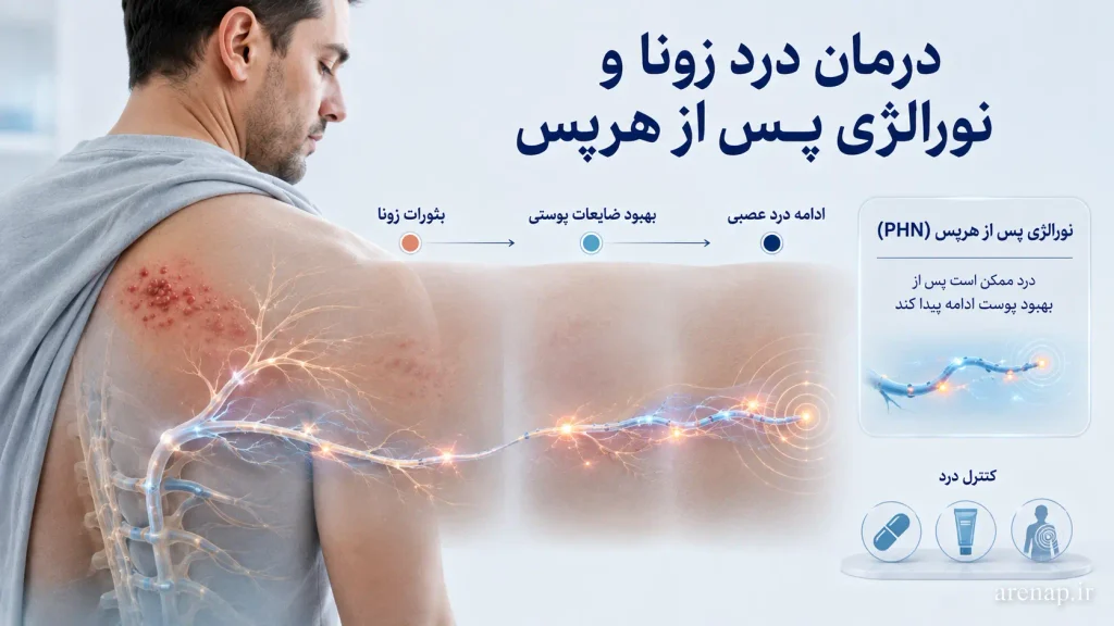 تصویر نورالژی پس از هرپس و ادامه درد عصبی پس از بهبود بثورات در روند درمان بیماری زونا