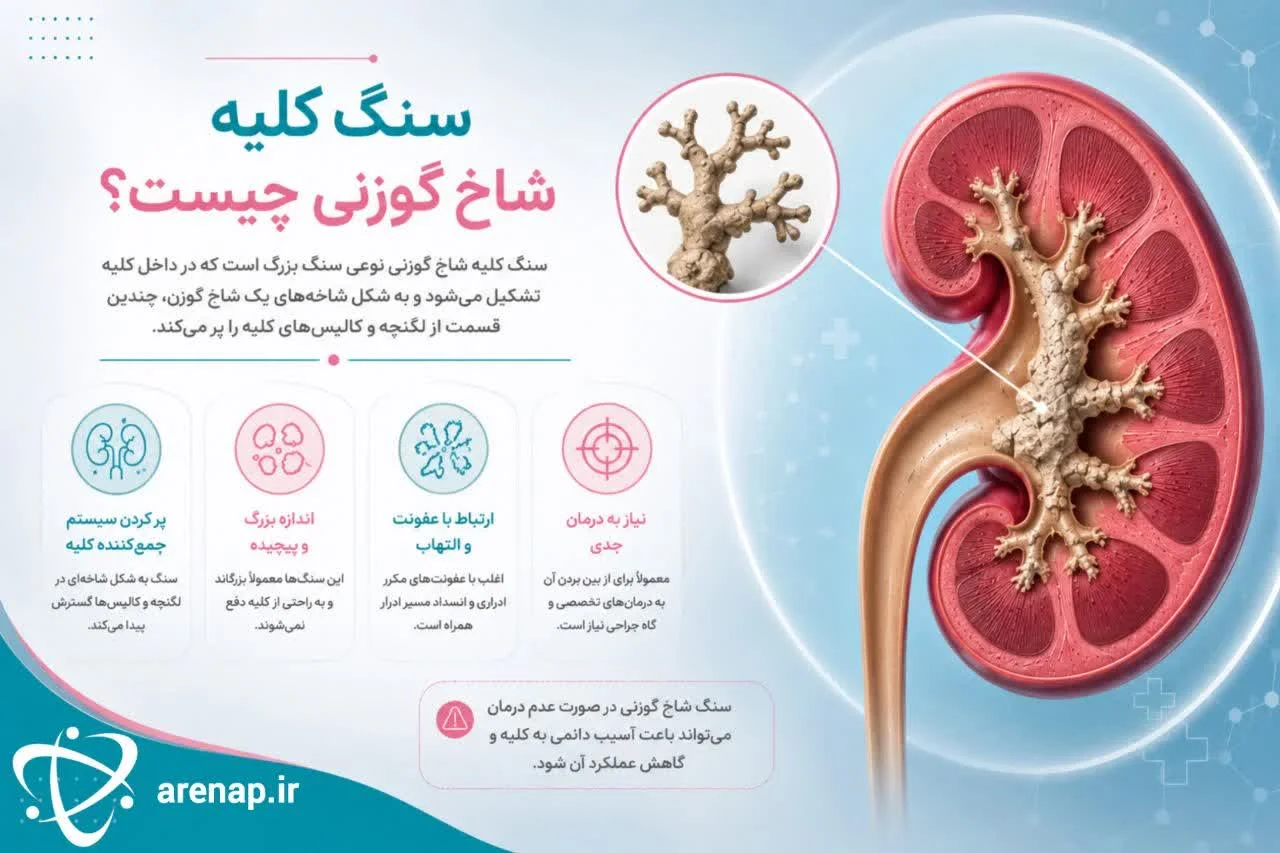 سنگ کلیه شاخ گوزنی چیست؟ -ارناپ