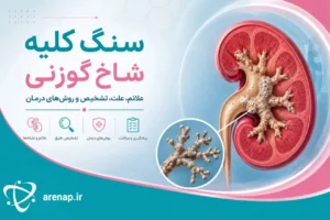 سنگ کلیه شاخ گوزنی - آرناپ