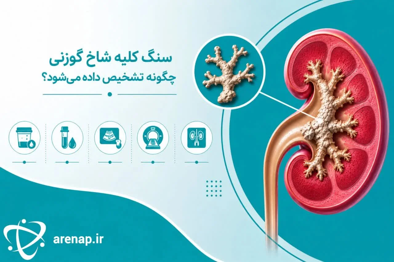 سنگ کلیه شاخ گوزنی چگونه تشخیص داده می‌شود؟ -ارناپ