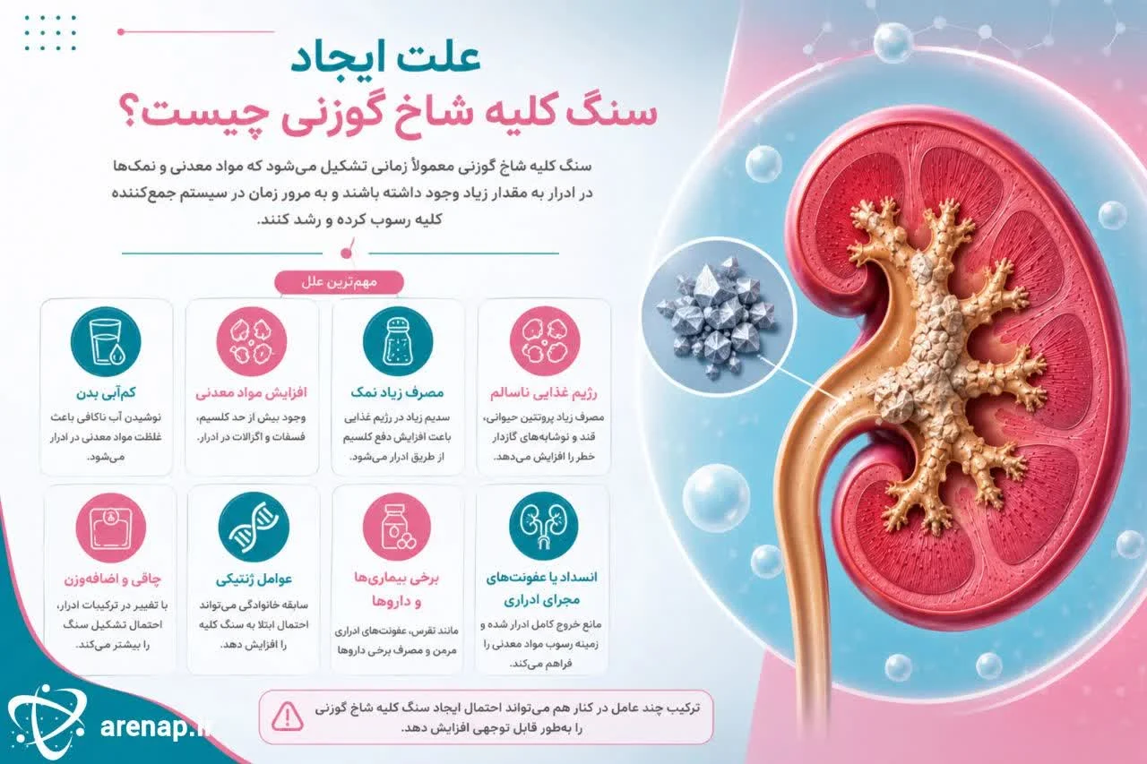 علت ایجاد سنگ کلیه شاخ گوزنی چیست؟ -ارناپ