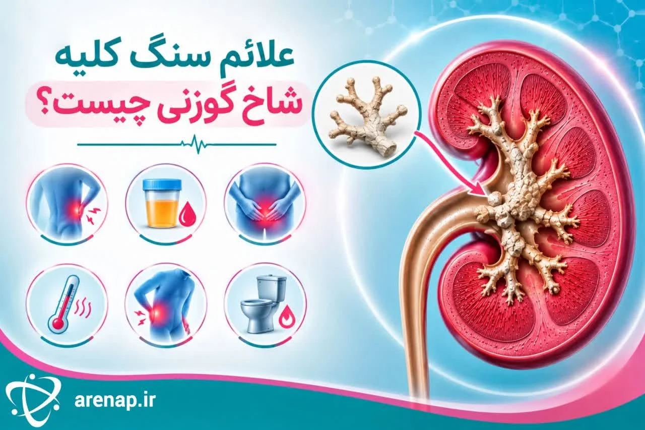 علائم سنگ کلیه شاخ گوزنی چیست؟ -ارناپ