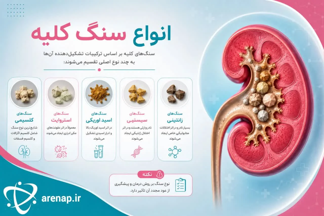 انواع سنگ کلیه -ارناپ