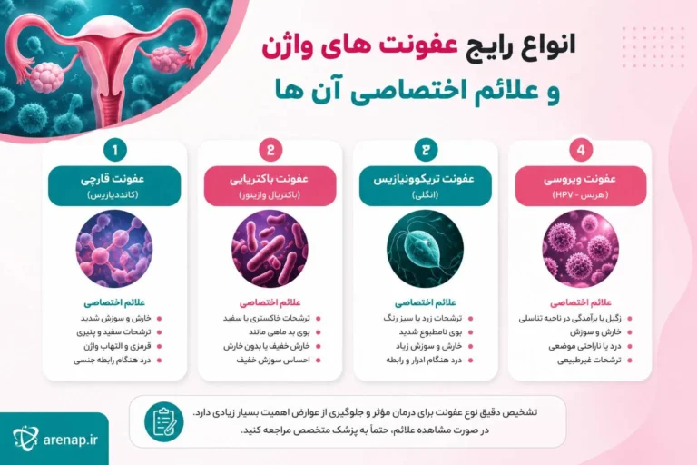 انواع عفونت واژن؛ عفونت قارچی واژن - آرناپ