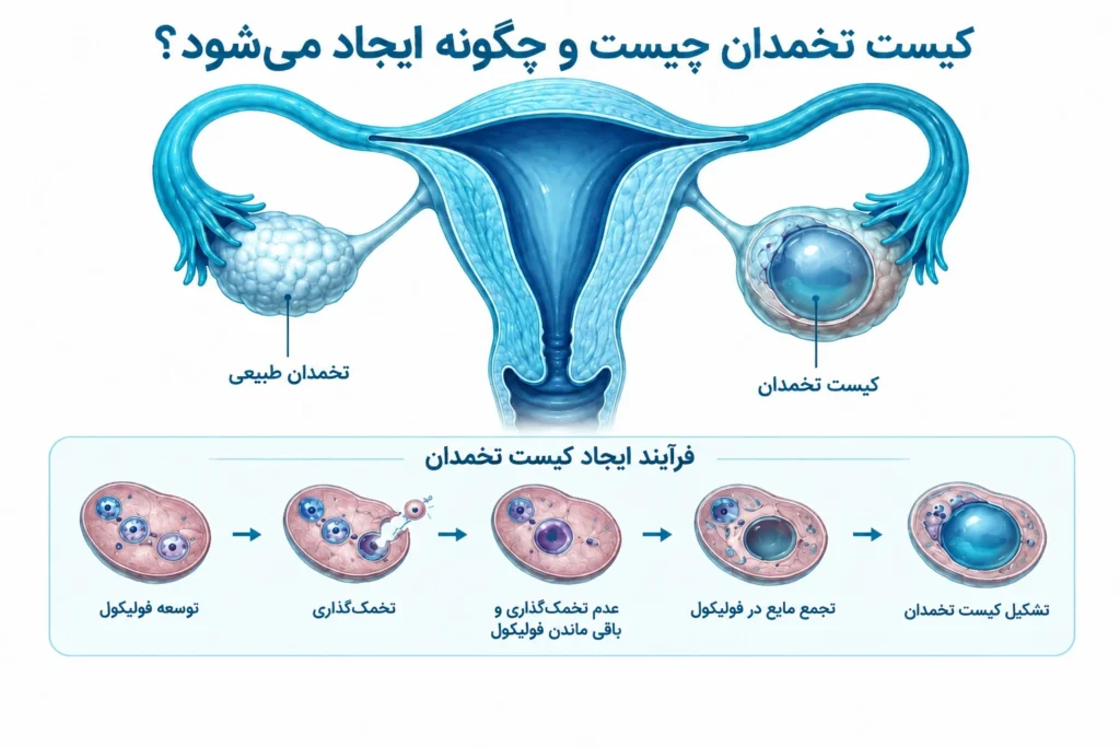 کیست تخمدان از چی تشکیل میشه - آرناپ